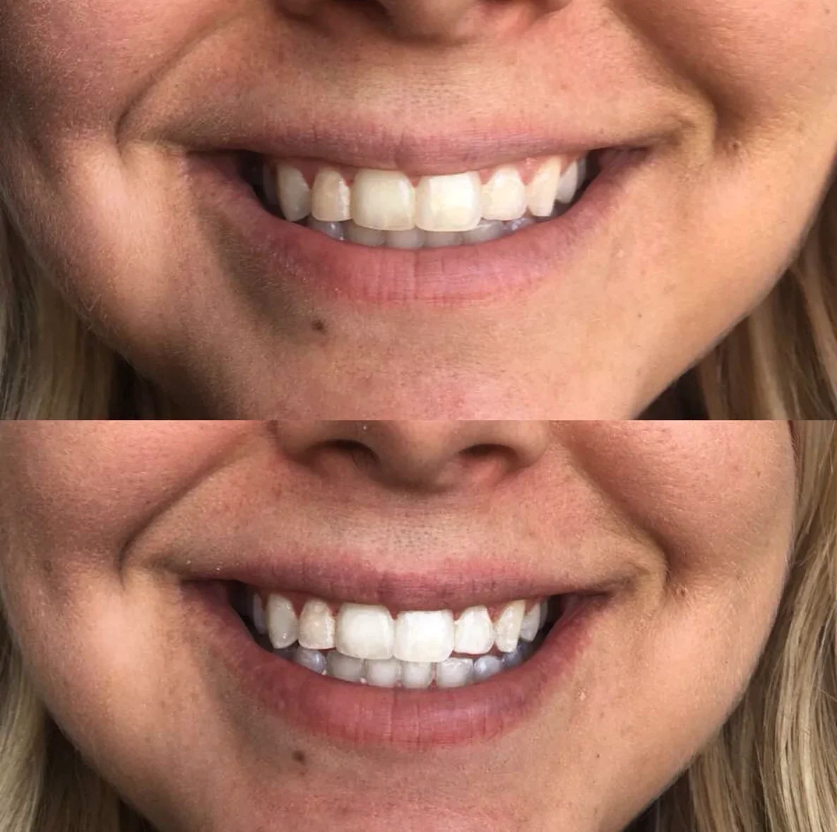 PREORDER: Cozy Smile Whitening Kit - Image 3
